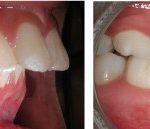 Chụp răng sứ lên răng thưa có được lâu không?